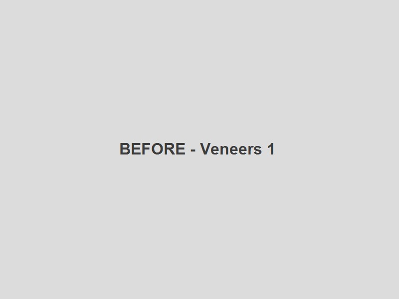 hero.altTexts.beforeVeneers